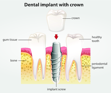 dental implants diagram chelsea heights 