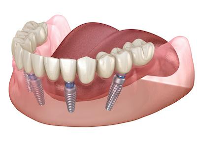 dental implants diagram | chelsea heights dentist