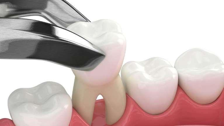 close up of dental tooth removing tooth | dentist near me