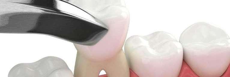 close up of dental tool on tooth | dentist near me chelsea heights