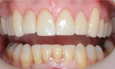 After treatment - Clear Aligners and Crowns/Veneers 