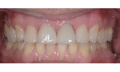 After treatment - Composite Veneers on Front Teeth