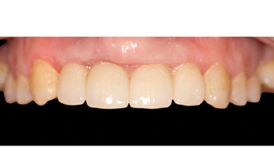 After treatment - Dental Implant and Bridge Treatment