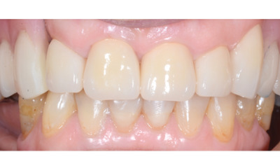 After treatment - Dentures, Crowns and Bite Reconstruction
