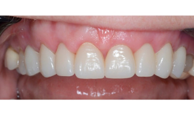 After treatment - Gum Lift, Crown and Veneers 