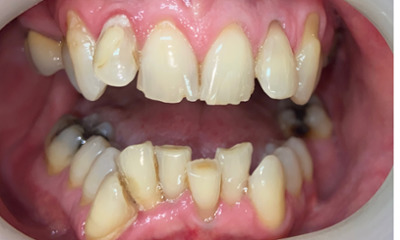 Before treatment - Clear Aligners and Crowns/Veneers 
