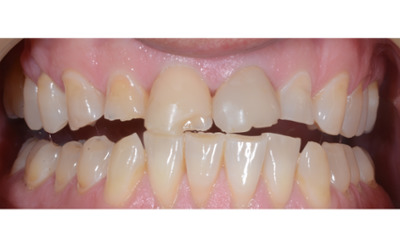 Before treatment - Composite Veneers on Front Teeth