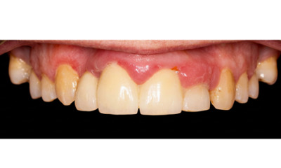 Before treatment - Dental Implant and Bridge Treatment