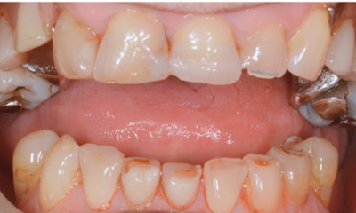 Before treatment - Dentures, Crowns and Bite Reconstruction
