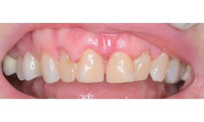 Before treatment - Gum Lift, Crown and Veneers 